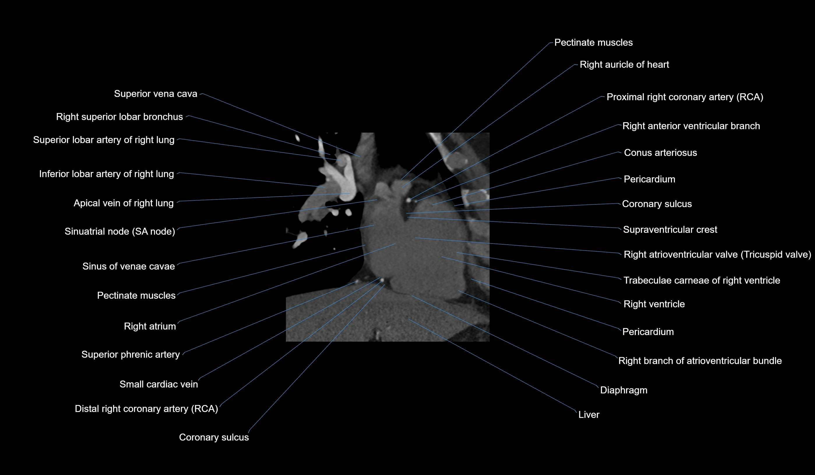 CT heart (coronary angiogram) 2 chamber view cross sectional anatomy labelled radiology image-00032.webp